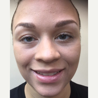 25-34 year old woman treated with Botox after 3443835