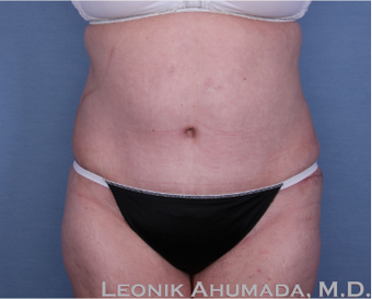 55-64 year old woman treated with Tummy Tuck after 2323418
