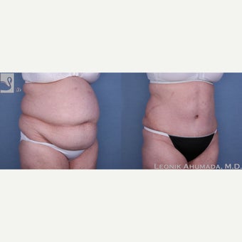 55-64 year old woman treated with Tummy Tuck 2323418