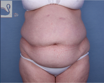 55-64 year old woman treated with Tummy Tuck before 2323418