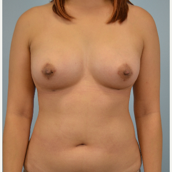 25-34 year old woman treated with Breast Fat Transfer after 3432059
