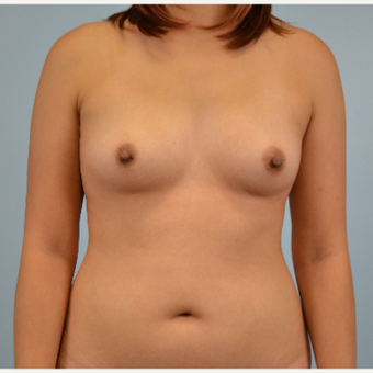 25-34 year old woman treated with Breast Fat Transfer before 3432059