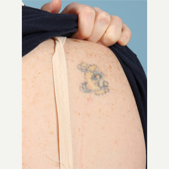 35-44 year old woman treated with Tattoo Removal before 3623135