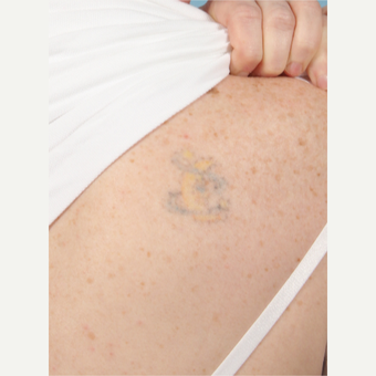 35-44 year old woman treated with Tattoo Removal after 3623135