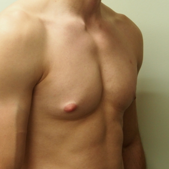 18-24 year old man treated with Male Breast Reduction before 3743424