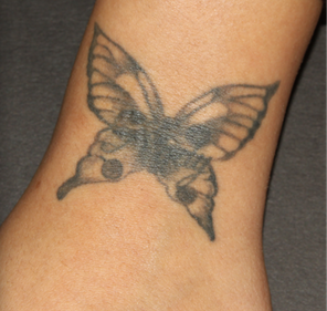 PicoSure Tattoo Removal before 1255538