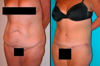 Tummy Tuck before 3037981