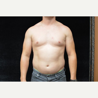 35-44 year old man treated with Abdominal Etching before 3327517