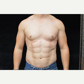 35-44 year old man treated with Abdominal Etching after 3327517