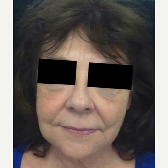 64 year old woman treated with Injectable Fillers for Facial Rejuvenation after 3645665