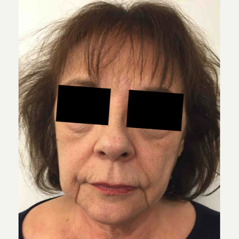 64 year old woman treated with Injectable Fillers for Facial Rejuvenation before 3645665