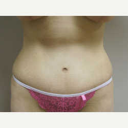38 year old woman treated with Tummy Tuck after 3484857