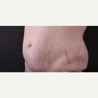 30 year old man treated with CoolSculpting before 3630340