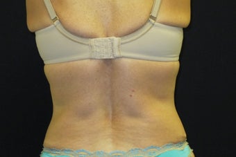 CoolSculpting Bilateral Love Handles after 1523554