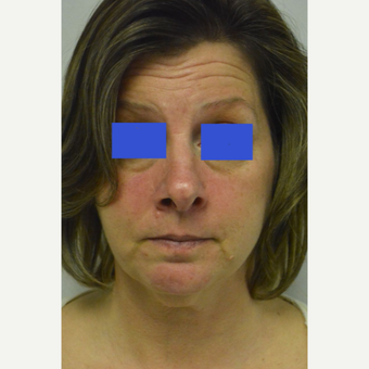 45-54 year old woman treated with Kybella before 3500789
