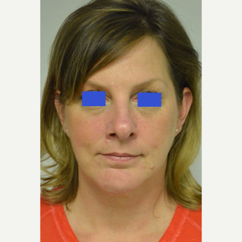 45-54 year old woman treated with Kybella after 3500789