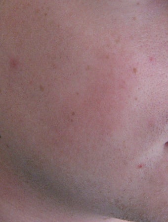 24 year old Male with Rosacea after 694718