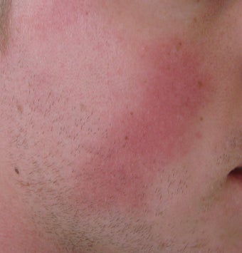 24 year old Male with Rosacea before 694718