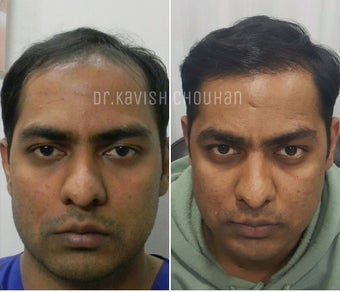 35-44 year old man treated with FUE Hair Transplant before 2827532
