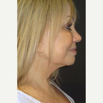 65-74 year old woman treated with Quick Lift before 2480777