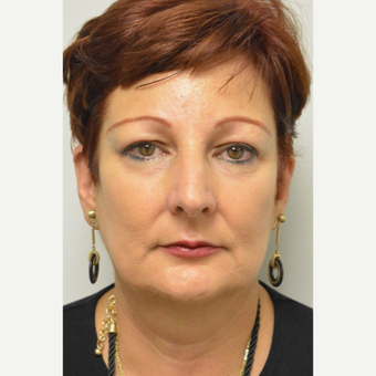 55-64 year old woman treated with upper Eyelid Surgery and endoscopic browlift after 3464259
