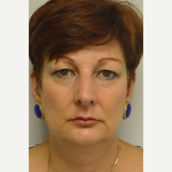 55-64 year old woman treated with upper Eyelid Surgery and endoscopic browlift before 3464259