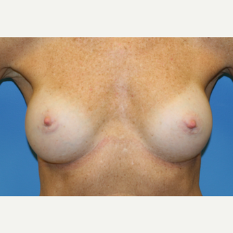 53 year old woman treated with Breast Augmentation after 3486683