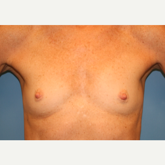 53 year old woman treated with Breast Augmentation before 3486683