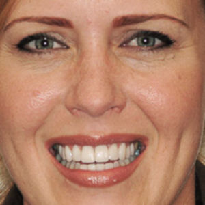 Porcelain Veneers after 3696250