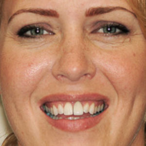 Porcelain Veneers before 3696250