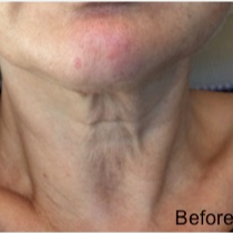 55-64 year old woman treated with Fractional Laser before 3174619