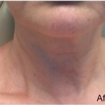 55-64 year old woman treated with Fractional Laser after 3174619