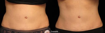 CoolSculpting® of waist/ flanks, 50 year old woman, six sites, one treatment. before 1244353