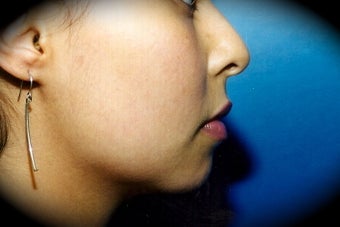Chin Augmentation before 837110