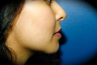 Chin Augmentation after 837110