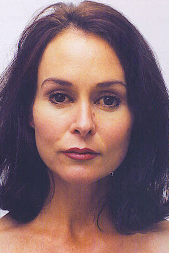 endoscopic browlift, quad blepharoplasty and septorhinoplasty after 301275