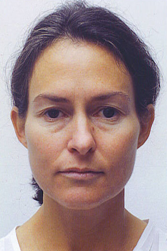 endoscopic browlift, quad blepharoplasty and septorhinoplasty before 301275