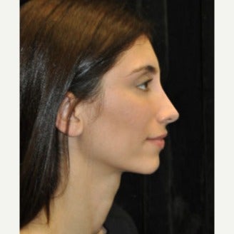Fat Transfer after 1638271