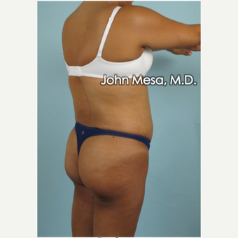 45-54 year old woman treated with Brazilian Butt Lift before 3777652
