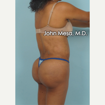 45-54 year old woman treated with Brazilian Butt Lift after 3777652