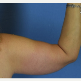 45-54 year old woman treated with Arm Lift after 3630332