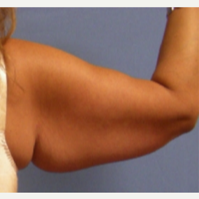45-54 year old woman treated with Arm Lift before 3630332