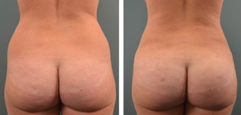 25-34 year old woman treated for Fat Transfer 1479496