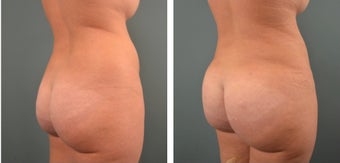 25-34 year old woman treated for Fat Transfer after 1479496