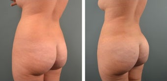 25-34 year old woman treated for Fat Transfer before 1479496