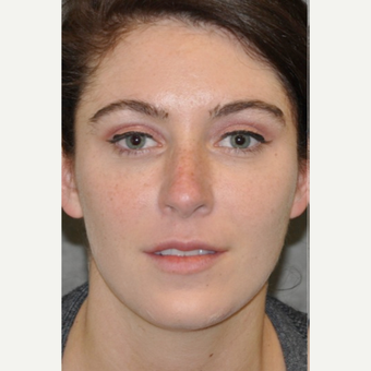 25-34 year old woman treated with Lifestyle Lift before 3175979