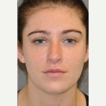 25-34 year old woman treated with Lifestyle Lift after 3175979