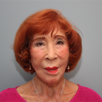 83 year old woman treated with a LiteLift® facelift after 3380077