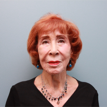 83 year old woman treated with a LiteLift® facelift before 3380077