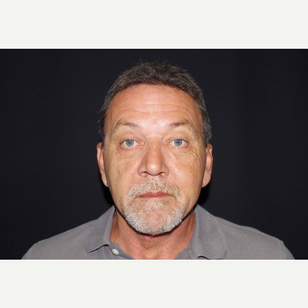 55-64 year old man treated with Direct Neck Lift after 3439245
